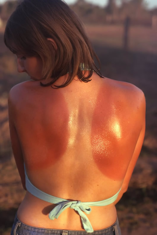 Sunburned in Bowen 1975